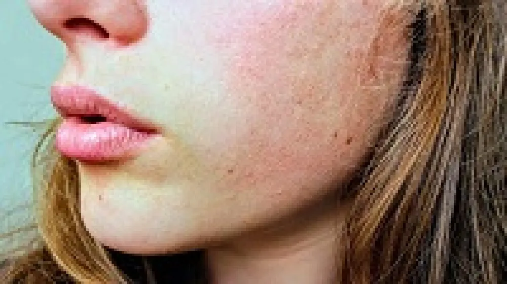 PCD Franchise For Anti Allergic Range