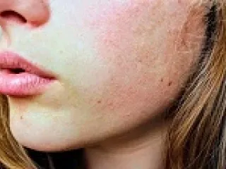 PCD Franchise For Anti Allergic Range